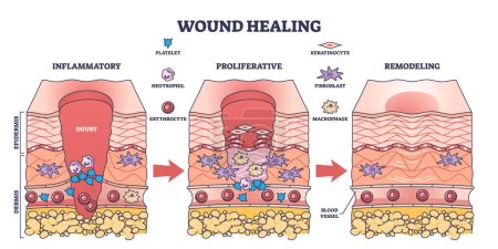 Illustration for Process of wound healing and anatomical body injury repair outline diagram. Labeled educational scheme with medical epidermis skin inflammatory, proliferative or remodeling stages vector illustration - Royalty Free Image
