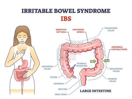Syndrome de l'intestin irritable ou IBS comme schéma de problèmes de santé digestive. Schéma éducatif étiqueté avec la maladie du tractus gastrique du corps et la maladie de l'estomac illustration vectorielle. Anatomie intestinale