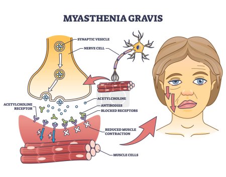 Illustration for Myasthenia gravis as autoimmune, neuromuscular disease outline diagram. Labeled educational medical scheme with skeletal muscles weakness symptoms vector illustration. Anatomical illness explanation. - Royalty Free Image