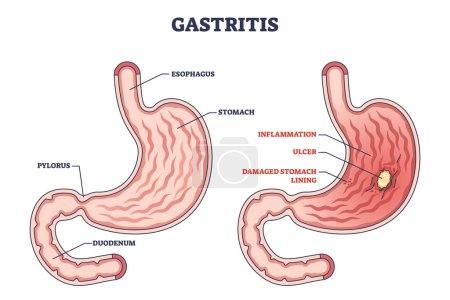 Illustration for Gastritis as stomach lining inflammation illness and disease outline diagram. Labeled educational gastric problem with burning and pain in intestinal tract vector illustration. Medical structure. - Royalty Free Image
