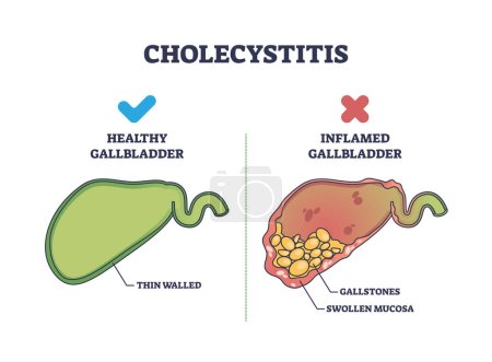 Cholecystitis als entzündete Gallenblase verglichen mit gesunden Umrissen. Beschriftetes Bildungsschema mit geschwollener Schleimhaut und Gallensteinen im Verdauungstrakt. Magenerkrankung.