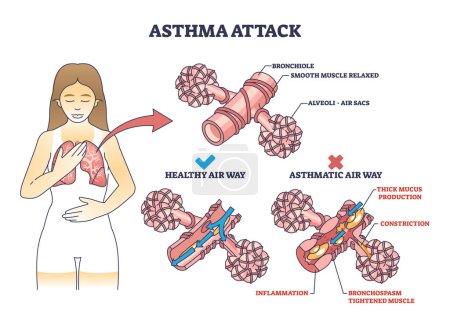 Explicación del ataque de asma en comparación con el diagrama del contorno de la vía aérea saludable. Esquema educativo etiquetado con producción de moco e inflamación en la ilustración de vectores pulmonares. Sistema respiratorio anatómico.