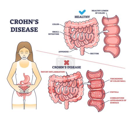Illustration for Crohns disease as inflammatory bowel problem explanation outline diagram. Labeled educational medical comparison with stomach illness and healthy colon, small intestine and gut vector illustration. - Royalty Free Image