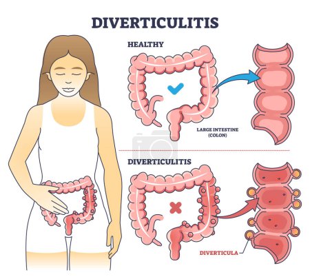 Illustration for Diverticulitis as digestive conditions for large intestine outline diagram. Labeled educational scheme with colon problem vector illustration. Anatomical explanation for digestive system inflammation - Royalty Free Image