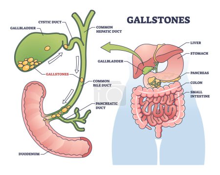Illustration for Gallstones as stones of cholesterol in gallbladder outline diagram. Labeled educational scheme with bile ducts blockage and painful problem vector illustration. Anatomical and medical explanation. - Royalty Free Image