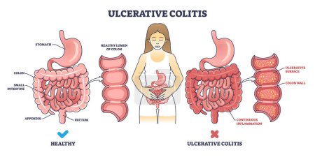 Illustration for Ulcerative colitis as chronic inflammatory bowel disease outline diagram. Labeled educational scheme with medical illness of digestive system vector illustration. Ulcers inflammation description. - Royalty Free Image