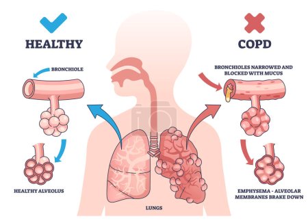 Ilustración de EPOC o enfermedad pulmonar obstructiva crónica explicación esquema diagrama. Esquema médico educativo etiquetado con enfermedades sanas y respiratorias ilustración de vectores de comparación de pulmones. Diagnóstico corporal - Imagen libre de derechos
