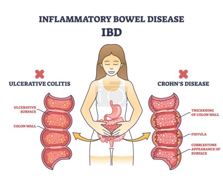 Illustration for Inflammatory bowel disease or IBD with Crohns condition and ulcerative colitis outline diagram. Labeled educational scheme with chronic inflammation of gastrointestinal tract vector illustration. - Royalty Free Image