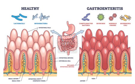 Gastroenteritis or stomach flu microbiological explanation outline diagram. Labeled educational scheme with healthy and bacteria, rotavirus or coli affected intestine comparison vector illustration.