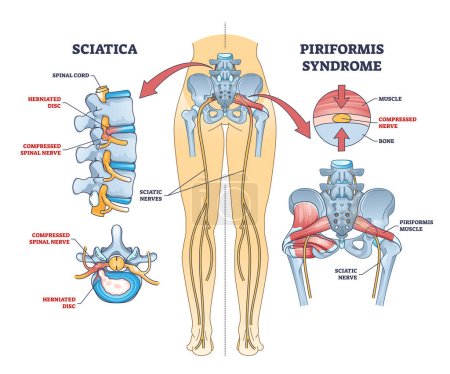 Sciatica vs piriformis medical muscle conditions comparison outline diagram. Labeled educational scheme with hip anatomy and compressed nerve or herniated disc caused acute pain vector illustration.