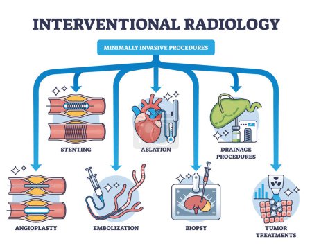 La radiología intervencionista como procedimientos mínimamente invasivos delinea el diagrama. Esquema educativo etiquetado con proceso de tratamiento de biopsia médica para tumores, stent e ilustración vectorial de angioplastia.