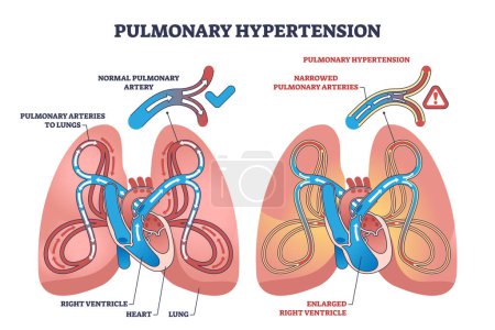 Illustration for Pulmonary hypertension with narrow arteries and blockage outline diagram. Labeled educational scheme with medical condition comparison with healthy lungs and respiratory system vector illustration. - Royalty Free Image