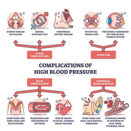 Complications of high blood pressure and possible diseases outline diagram. Labeled educational scheme with potential vision loss, chest pain, heart attack, strokes and failures vector illustration.
