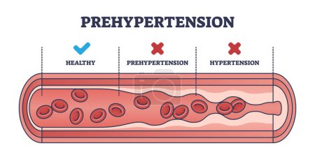 Prehypertension, healthy and hypertension blood flow comparison outline diagram. Labeled educational scheme with medical vessels and artery conditions for high blood pressure vector illustration.