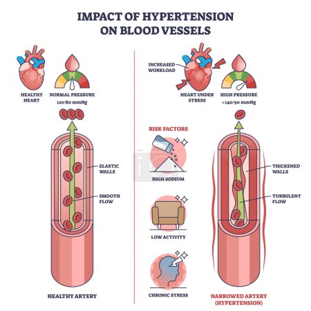 hipertension
