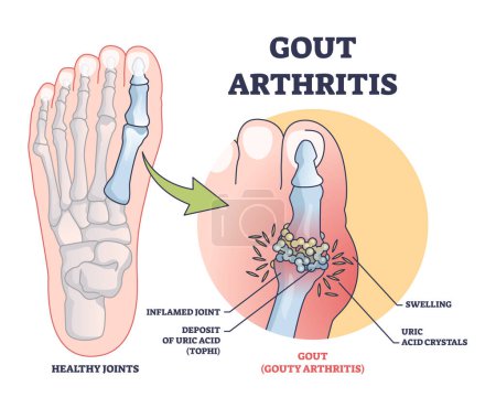 Gouty Arthritis mit entzündeten Zehengelenken schmerzhaften Zustand umreißen Diagramm. Beschriebenes Bildungsschema mit medizinischen Erkrankungen und Fußschwellungen aufgrund von Harnsäure-Kristallen-Ablagerungsvektorveranschaulichung.
