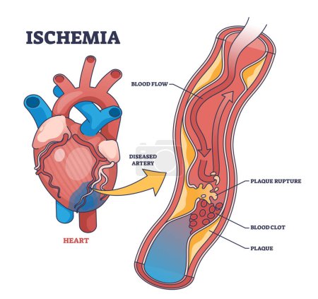 Isquemia como condición médica con diagrama de esquema de bloqueo del flujo sanguíneo. Esquema de anatomía educativa etiquetada con rotura de placa, coágulo de sangre y flujo restringido o reducido a la ilustración de vectores cardíacos.