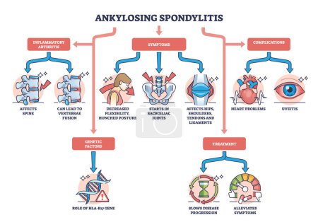 Illustration for Ankylosing spondylitis as arthritis symptoms or complications outline diagram. Labeled educational medical scheme with spine inflammation illness and condition vector illustration. Back bone disease. - Royalty Free Image