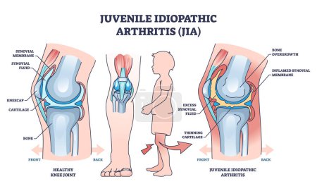 Illustration for Juvenile idiopathic arthritis or JIA anatomical explanation outline diagram. Labeled educational medical scheme with healthy and diseased joint comparison vector illustration. Child bone illness. - Royalty Free Image