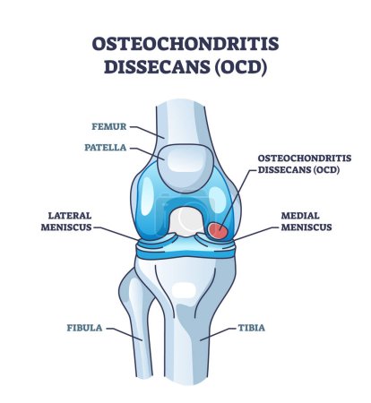 Illustration for Osteochondritis dissecans or OCD bone and cartilage condition outline diagram. Labeled educational scheme with meniscus and leg bone orthopedics problem from chronic overuse vector illustration. - Royalty Free Image