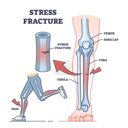 Illustration for Stress fracture and skeletal bone injury after physical overuse outline diagram. Labeled educational scheme with painful athletes health condition after high physical activity vector illustration. - Royalty Free Image
