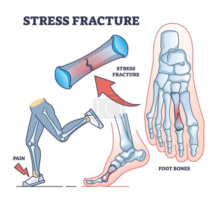Illustration for Stress fracture explanation with skeletal foot bone injury outline diagram. Labeled educational scheme with phalanges tear after physical running activities and overuse in walking vector illustration - Royalty Free Image