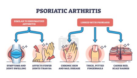 Psoriatic arthritis as chronic dermatological skin condition outline diagram. Labeled educational scheme with illness symptoms like joint swelling, pitted fingernails and rashes vector illustration.