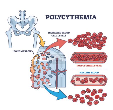 Tipo de cáncer de sangre de Polycythemia vera con diagrama de contorno de glóbulos rojos aumentado. Esquema educativo etiquetado con primer plano de médula ósea aislada e ilustración vectorial de comparación de vasos. Oncología ósea.