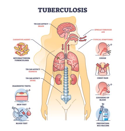 Ilustración de Aspectos clave de la tuberculosis o TB enfermedad pulmonar bacteriana esquema diagrama. Esquema educativo etiquetado con enfermedades respiratorias con tos, dolor torácico y tos hasta síntomas sanguíneos ilustración vectorial - Imagen libre de derechos