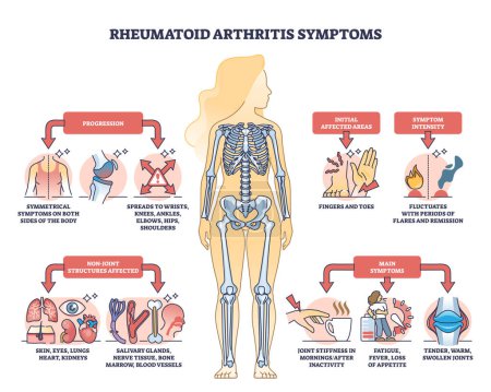 Illustration for Rheumatoid arthritis symptoms with joint inflammation disease outline diagram. Labeled educational chronic illness description scheme with progression and affected body areas vector illustration. - Royalty Free Image