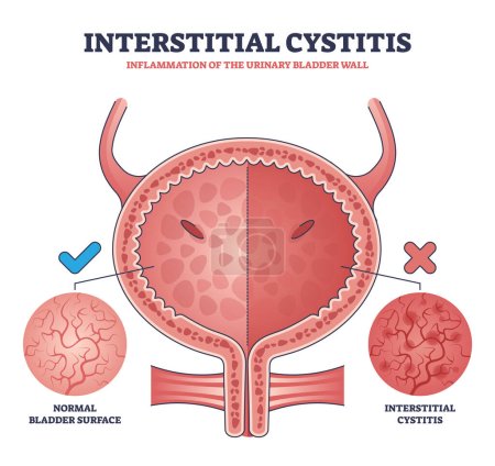 Cystite interstitielle comme schéma de contour d'inflammation de la paroi de la vessie. Problème d'urologie éducative étiqueté et comparaison de la surface de la vessie saine avec l'illustration vectorielle de condition enflammée.