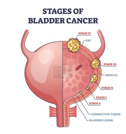 Stages of bladder cancer with anatomical oncology model outline diagram. Labeled educational scheme with illness growth and medical condition development vector illustration. Pathology diagnosis.