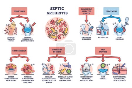 Illustration for Septic arthritis as joint infection and infection in bone outline diagram. Labeled educational scheme with symptoms, transmission, risk factors and treatment vector illustration. Medical disease. - Royalty Free Image