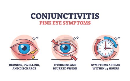 Illustration for Conjunctivitis or pink eye symptoms with simple explanation outline diagram. Labeled educational scheme with first appearance of redness, swelling, itchiness and blurred vision vector illustration. - Royalty Free Image