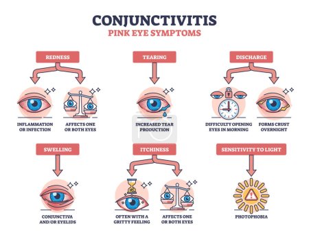 Illustration for Conjunctivitis or pink eye symptoms with medical examples outline diagram. Labeled educational scheme with affected redness, tearing, swelling, itchiness and sensitivity to light vector illustration. - Royalty Free Image