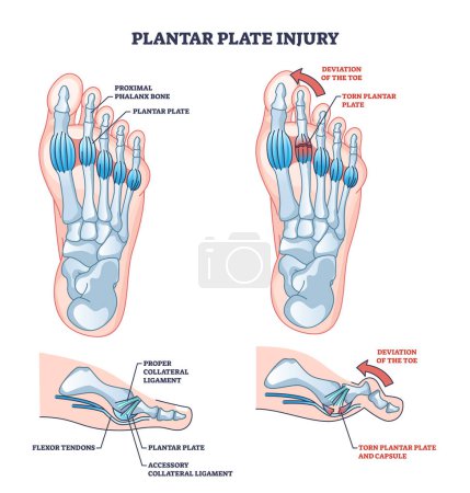 Plantar plate injury anatomy and foot capsule torn trauma outline diagram. Labeled educational scheme with skeletal foot problem and toe deviation vector illustration. Collateral ligament condition.