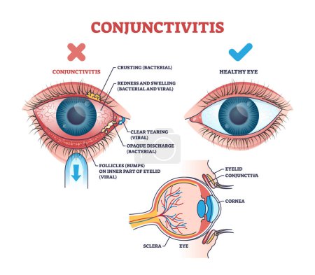 Conjonctivite oeil rose explication de l'état de santé schéma. Schéma éducatif étiqueté avec comparaison de lentilles saines avec une infection virale ou bactérienne et une inflammation vectorielle illustration.