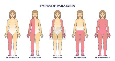 Illustration for Types of paralysis and limb body parts as medical condition outline diagram. Labeled educational scheme with monoplegia, hemiplegia, diplegia and paraplegia disorder differences vector illustration. - Royalty Free Image