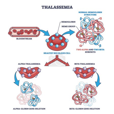 Illustration for Thalassemia blood disease as hemoglobin structure deletion outline diagram. Labeled educational scheme with alpha and beta globin subunits disorder vector illustration. Medical illness explanation. - Royalty Free Image