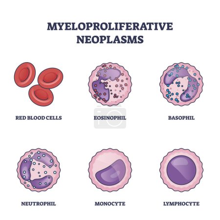 Myeloproliferative neoplasms as bone marrow blood diseases outline diagram. Labeled educational scheme with medical eosinophil, basophil, neutrophil, monocyte and lymphocyte list vector illustration.