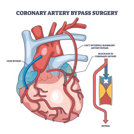 Illustration for Coronary artery bypass surgery for blocked blood flow outline diagram. Labeled educational scheme with heart procedure and cardiology condition vector illustration. Medical cardiovascular treatment. - Royalty Free Image