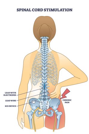 Ilustración de Dispositivo de estimulación de la médula espinal para el esquema de alivio del dolor de espalda crónico. Esquema educativo etiquetado con procedimiento médico para ayudar a los pacientes después de traumatismo espinal o lesión vector ilustración. - Imagen libre de derechos