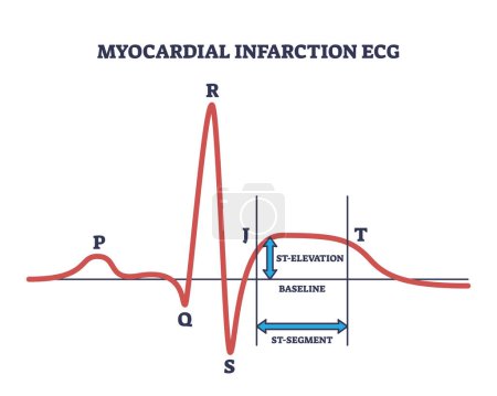 Illustration for Myocardial infraction ECG with abnormal ST segment elevation outline diagram. Labeled educational scheme with medical example of heart rate abnormality vector illustration. Heart pulse cardiac issue. - Royalty Free Image