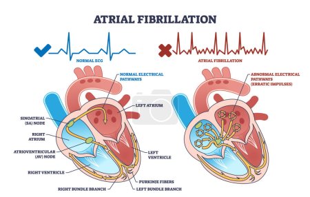 La fibrilación auricular como frecuencia anormal de latidos cardíacos diagrama de esquema de la enfermedad. Esquema educativo etiquetado con condición cardiovascular e ilustración de vector de estructura cardíaca. Explicación anatómica.