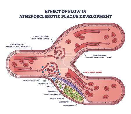 Effect of flow in atherosclerotic plaque development outline diagram. Labeled educational cardiovascular condition of artery thickening or hardening issue vector illustration. Inner lining buildup.