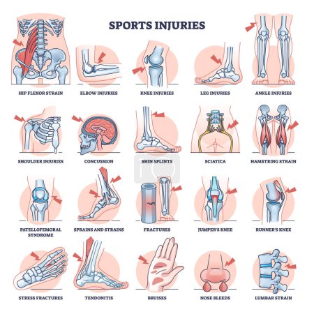 Illustration for Sport injuries and most common athlete traumas outline collection set. Labeled medical list with health problems and training accidents with trains, fractures, sprains and splints vector illustration - Royalty Free Image
