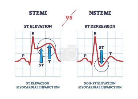 Téléchargez les illustrations : STEMI vs impulsion de battement cardiaque NSTEM dans le diagramme de contour de visualisation cardio. EKG ou électrocardiogramme avec illustration vectorielle de comparaison de l'élévation ST et de la dépression. Exemple d'infarctus du myocarde. - en licence libre de droit