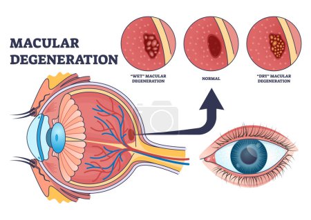 Makuladegeneration als Augenkrankheit und Sehstörungen skizzieren das Diagramm. Beschriebenes Bildungsschema mit zentraler Sehschwäche mit nassen oder trockenen Typen als Vektorillustration. Gesundheit der Netzhaut.