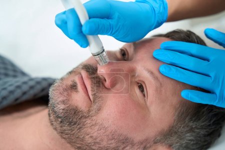 Foto de Cosmetólogo utiliza el método de microdermoabrasión no quirúrgica en su trabajo, el paciente es tratado con problemas estéticos en la nariz - Imagen libre de derechos
