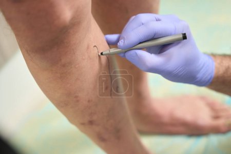 Photo for Cut photo of the patient legs on which the surgeon marking the veins with varicose veins with a marker - Royalty Free Image